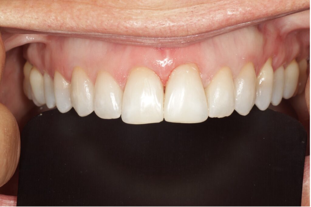 Teeth Straightening Willesden