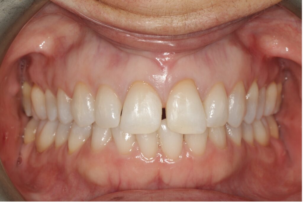 Teeth Straightening Willesden