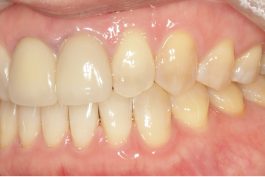 Teeth Straightening Willesden