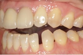Teeth Straightening Willesden